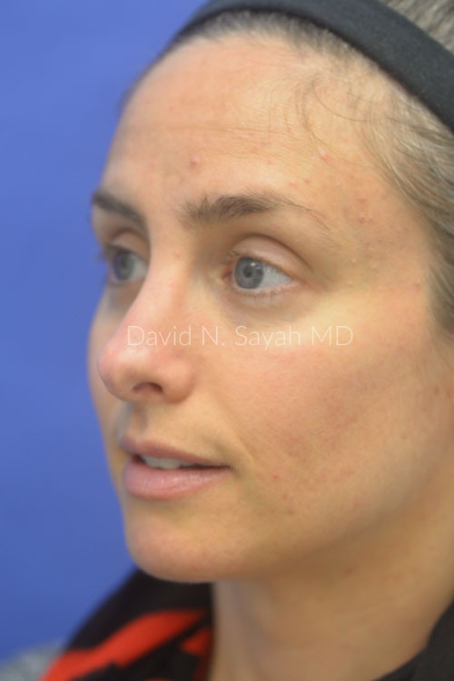 Rhinoplasty Before and After | Sayah Institute