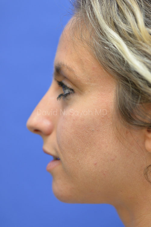 Rhinoplasty Before and After | Sayah Institute