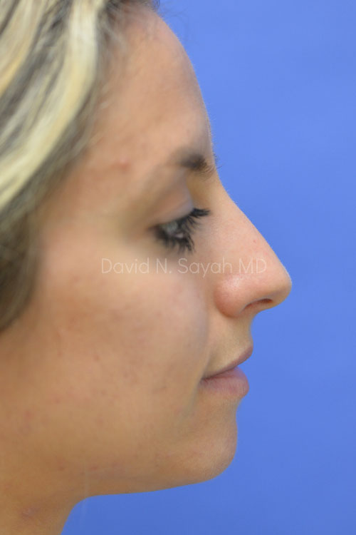 Rhinoplasty Before and After | Sayah Institute