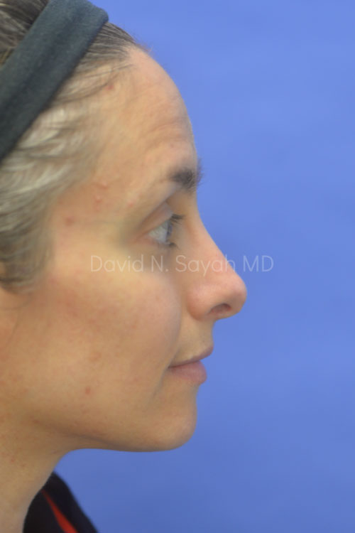 Rhinoplasty Before and After | Sayah Institute