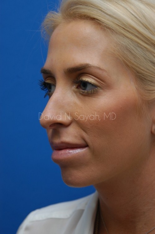 Rhinoplasty Before and After | Sayah Institute