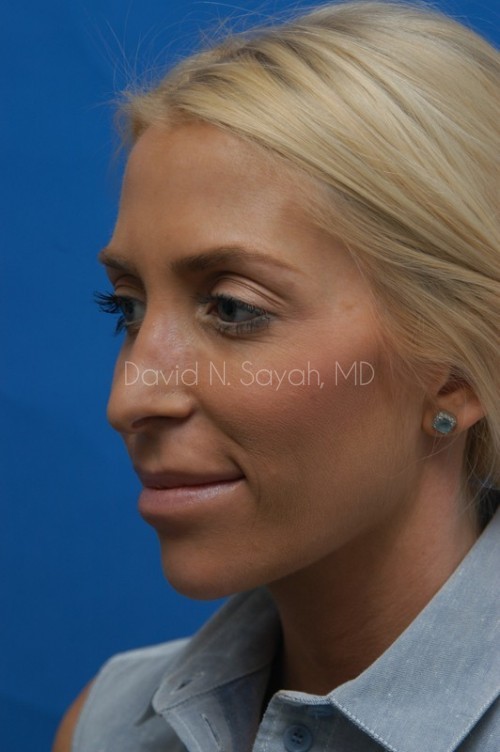 Rhinoplasty Before and After | Sayah Institute