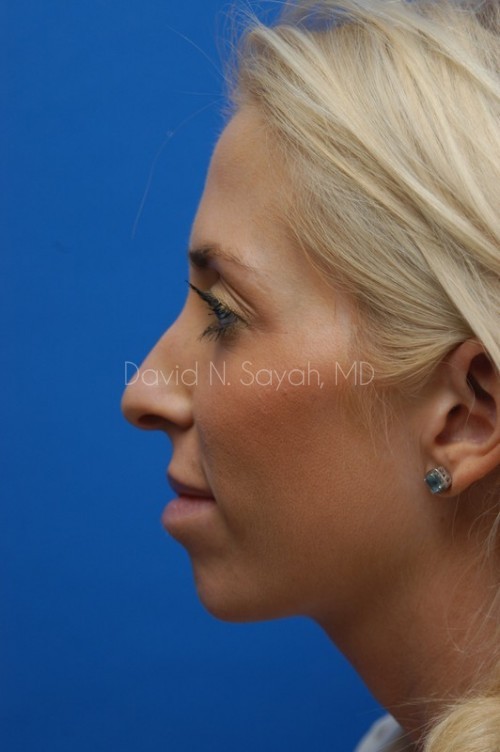 Rhinoplasty Before and After | Sayah Institute