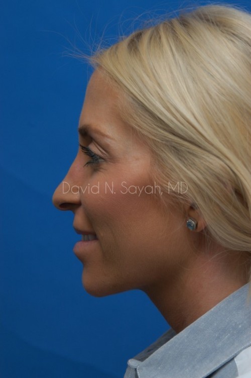 Rhinoplasty Before and After | Sayah Institute