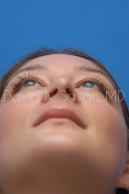 Rhinoplasty Before and After | Sayah Institute