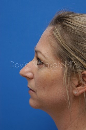 Rhinoplasty Before and After | Sayah Institute