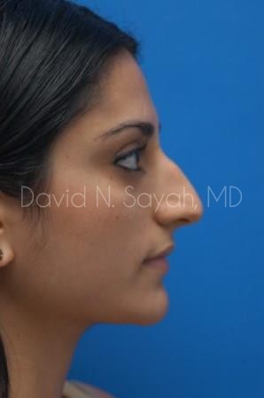 Rhinoplasty Before and After | Sayah Institute