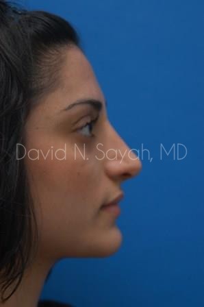 Rhinoplasty Before and After | Sayah Institute