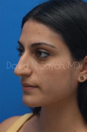 Rhinoplasty Before and After | Sayah Institute