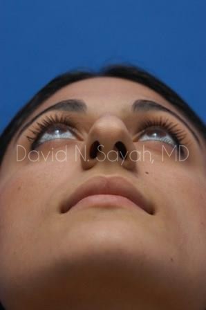 Rhinoplasty Before and After | Sayah Institute