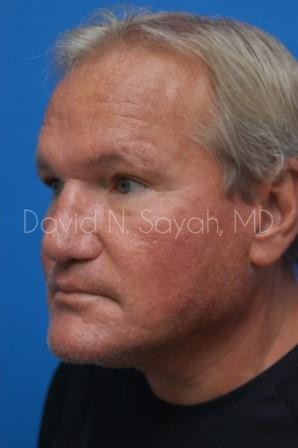 Rhinoplasty Before and After | Sayah Institute