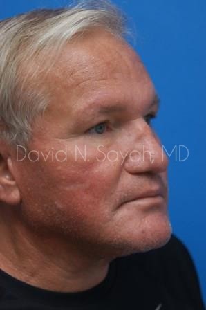 Rhinoplasty Before and After | Sayah Institute