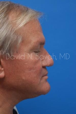 Rhinoplasty Before and After | Sayah Institute