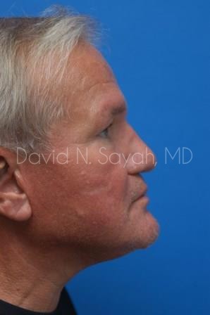 Rhinoplasty Before and After | Sayah Institute