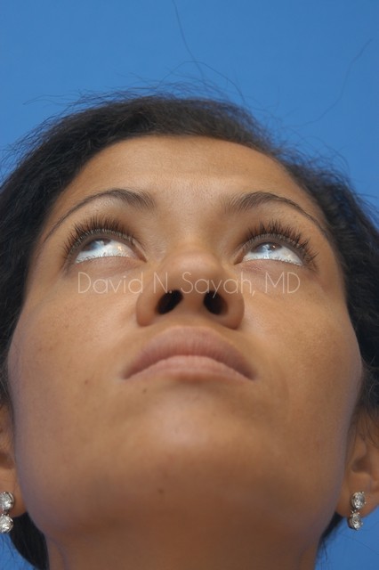 Rhinoplasty Before and After | Sayah Institute