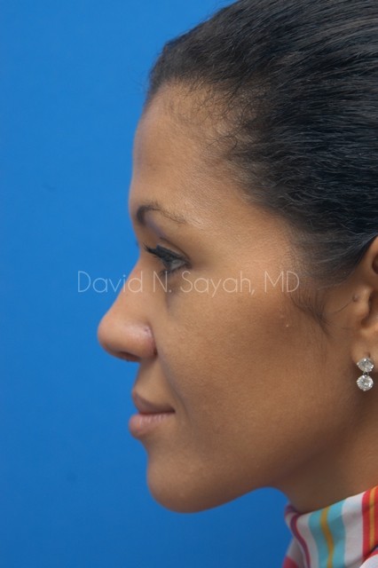 Rhinoplasty Before and After | Sayah Institute