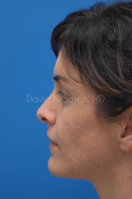 Rhinoplasty Before and After | Sayah Institute