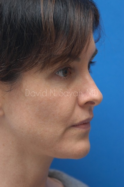 Rhinoplasty Before and After | Sayah Institute