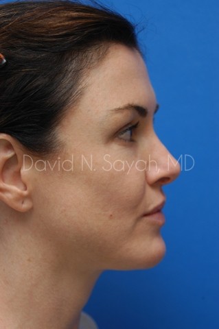 Rhinoplasty Before and After | Sayah Institute