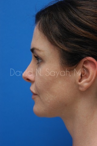 Rhinoplasty Before and After | Sayah Institute