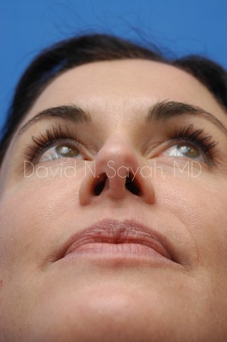 Rhinoplasty Before and After | Sayah Institute