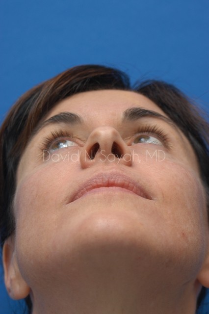 Rhinoplasty Before and After | Sayah Institute