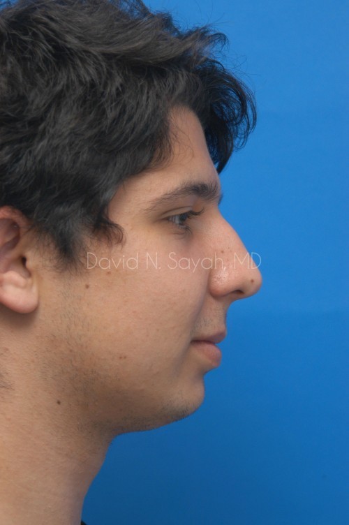 Rhinoplasty Before and After | Sayah Institute