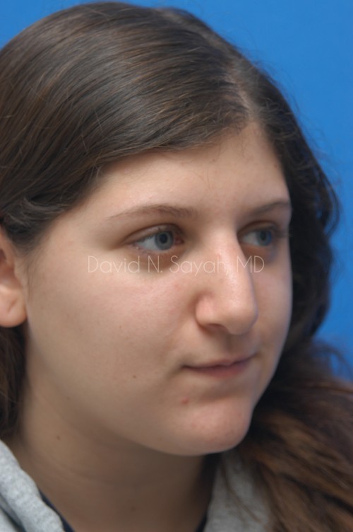 Rhinoplasty Before and After | Sayah Institute