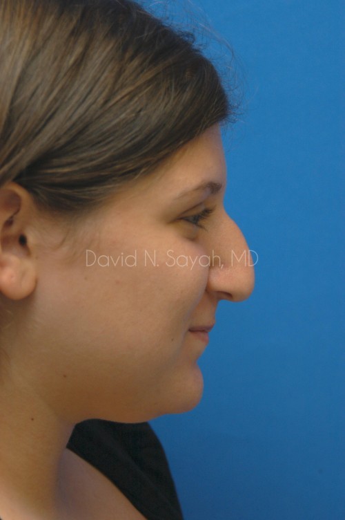 Rhinoplasty Before and After | Sayah Institute