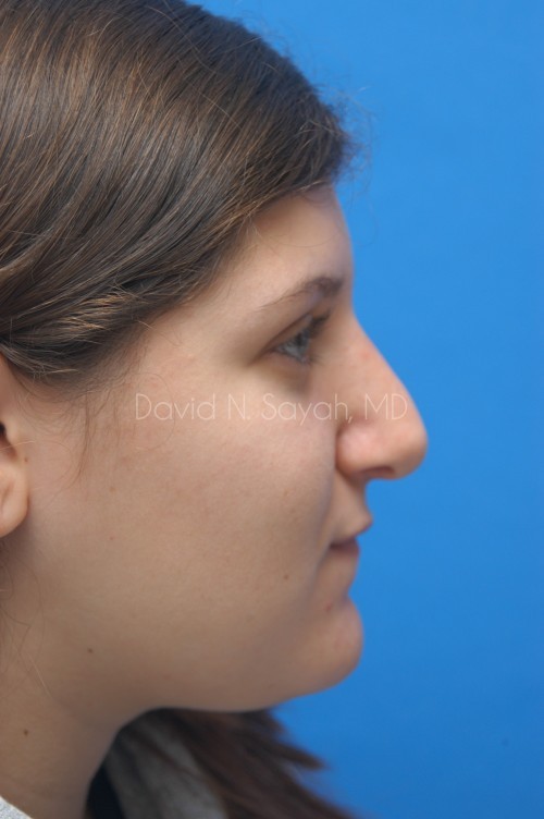 Rhinoplasty Before and After | Sayah Institute