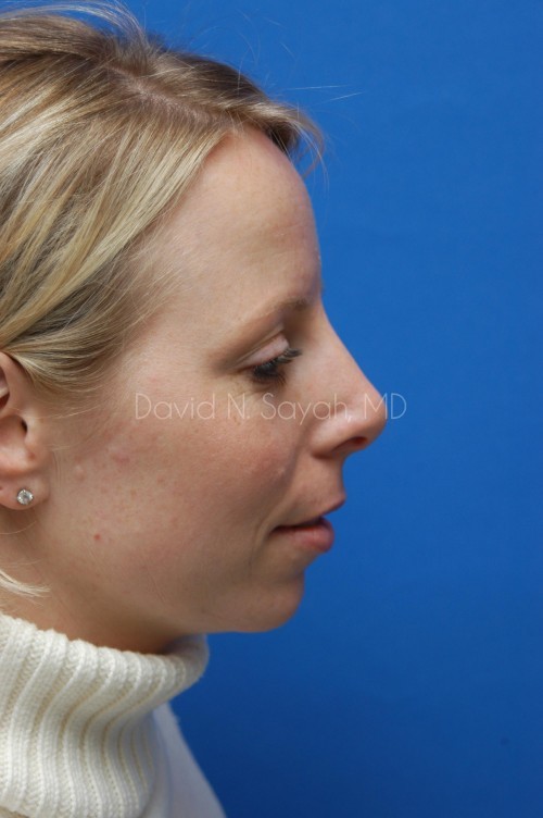 Rhinoplasty Before and After | Sayah Institute