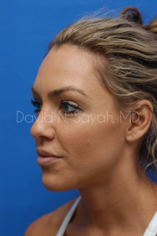 Rhinoplasty Before and After | Sayah Institute