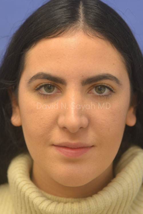 Rhinoplasty Before and After | Sayah Institute