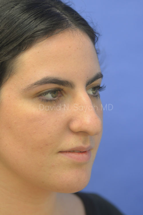 Rhinoplasty Before and After | Sayah Institute