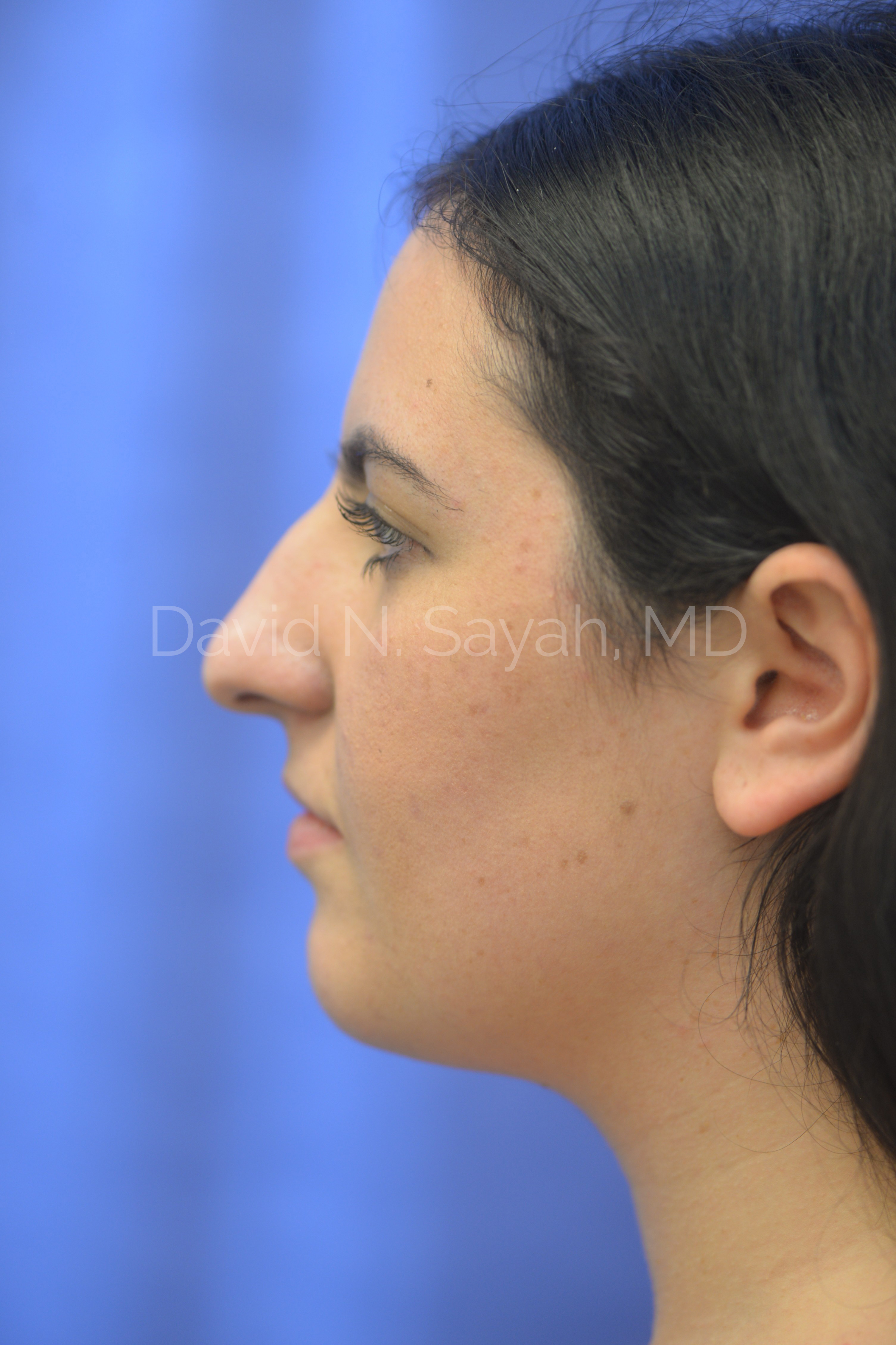 Rhinoplasty Before and After | Sayah Institute