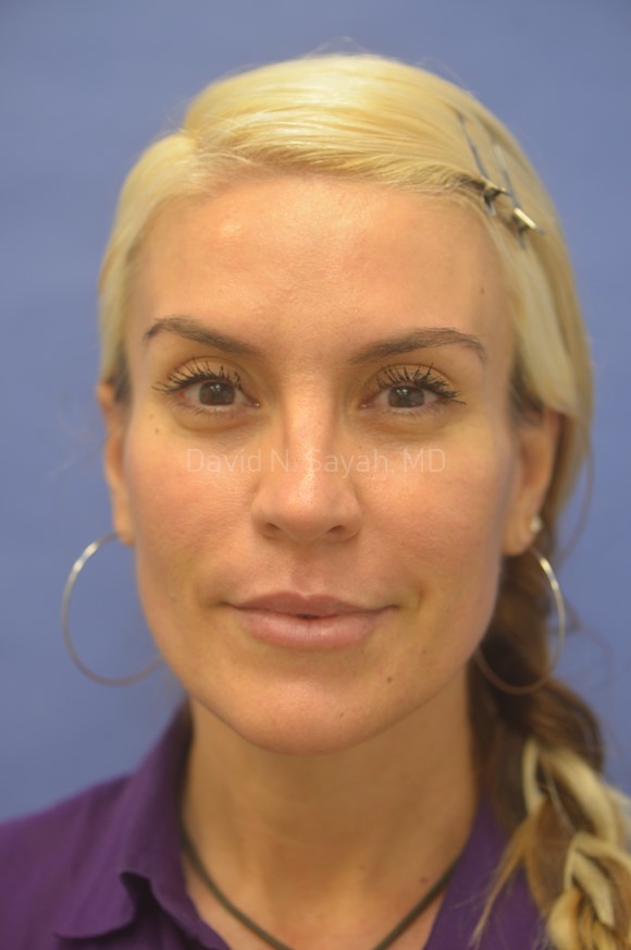 Rhinoplasty Before and After | Sayah Institute