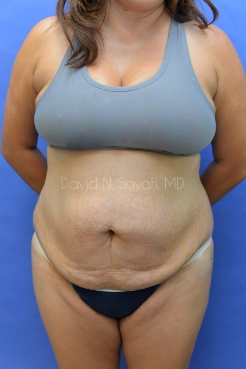 Scar Revision Body Before and After | Sayah Institute