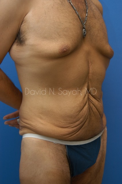 Scar Revision Body Before and After | Sayah Institute