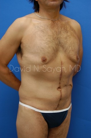 Scar Revision Body Before and After | Sayah Institute