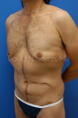 Scar Revision Body Before and After | Sayah Institute