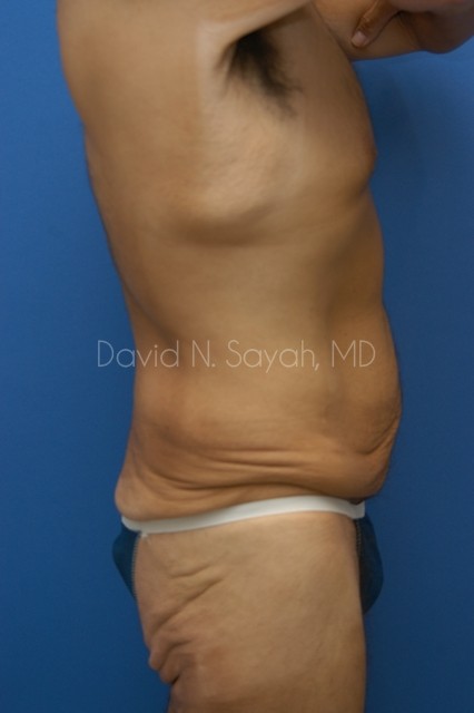 Scar Revision Body Before and After | Sayah Institute