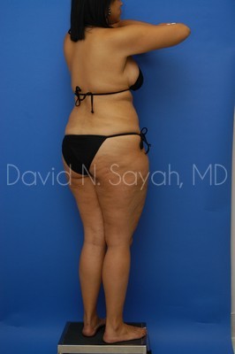 Thigh Lift Before and After | Sayah Institute