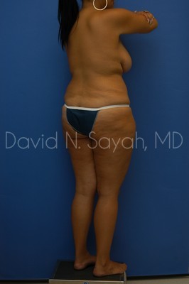 Thigh Lift Before and After | Sayah Institute