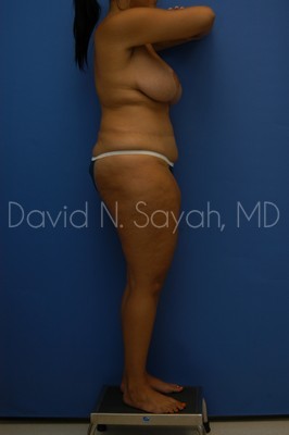 Thigh Lift Before and After | Sayah Institute