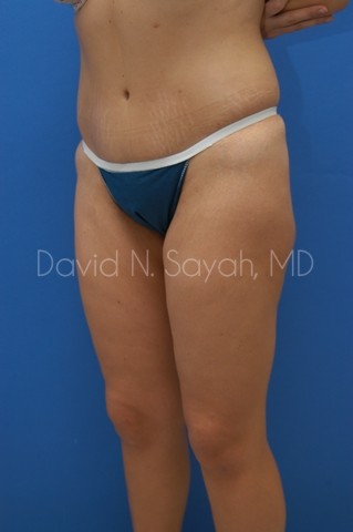 Thigh Lift Before and After | Sayah Institute