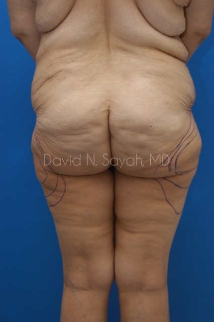 Thigh Lift Before and After | Sayah Institute