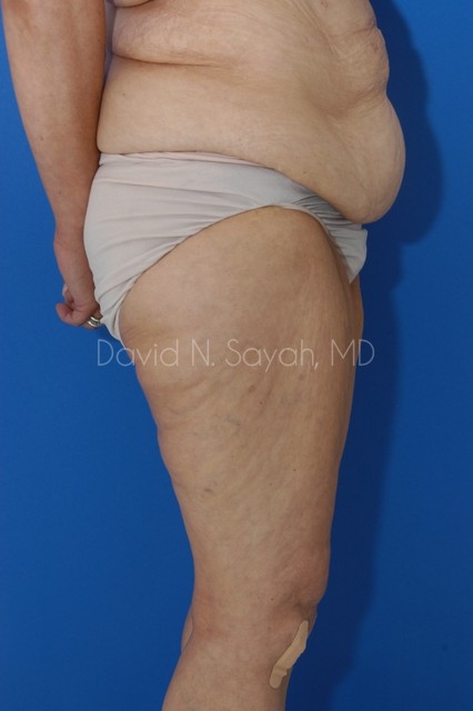 Thigh Lift Before and After | Sayah Institute