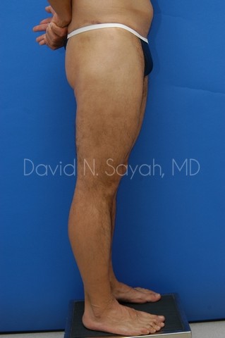 Thigh Lift Before and After | Sayah Institute