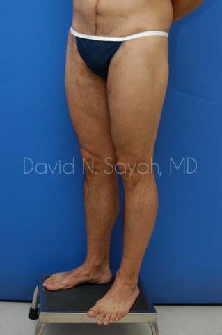 Thigh Lift Before and After | Sayah Institute