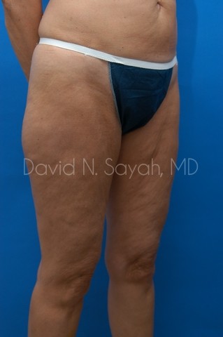 Thigh Lift Before and After | Sayah Institute